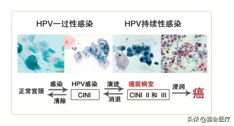 hpv感染医生建议检查宫腔镜,感染hpv产检能发现吗