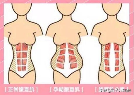 产后腹直肌分离修复手法教程,腹直肌分离瑜伽好还是电疗好