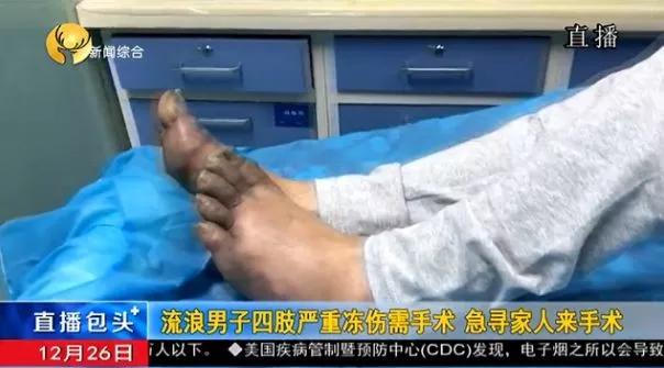 内蒙古一男子四肢严重冻伤需手术,急寻家人