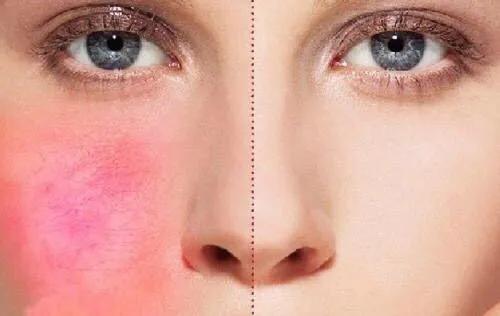 用化妆品一星期过敏,抹化妆品过敏怎么办