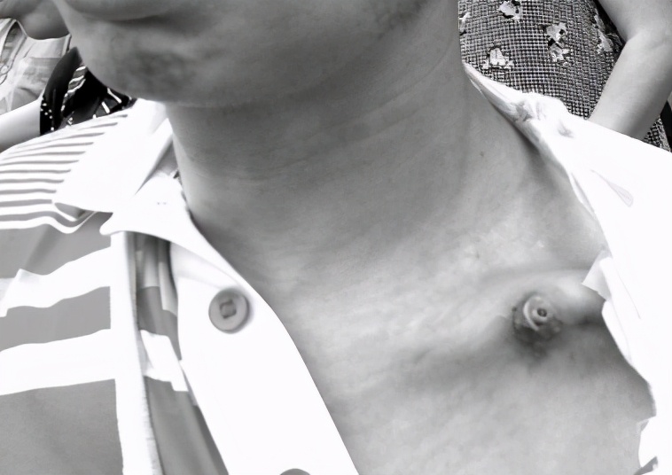 硬化性骨髓炎的临床症状,硬化性骨髓炎会遗传吗