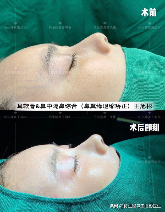 王旭彬:朝天鼻、露鼻孔,模特菲菲短鼻矫正手术后1.5个月