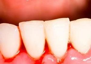 一碰就出血不易止住,轻轻一碰就出血是什么原因