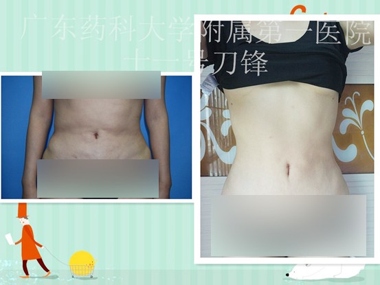 大腿吸脂失败了什么时候可以修复,吸脂失败后如何修复