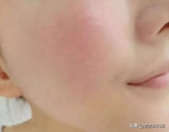 修复角质层薄红血丝敏感肌擦什么,角质层薄红血丝敏感肌肤用什么药