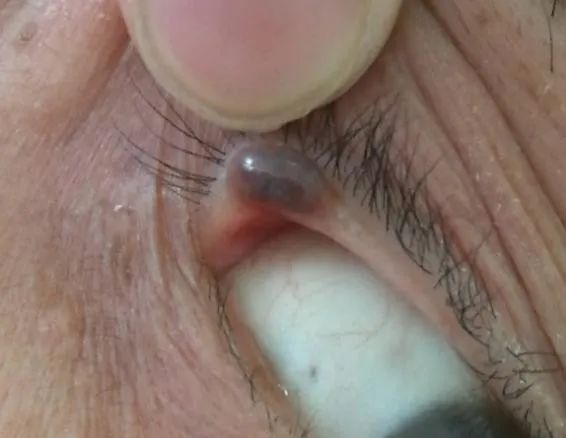 眼整形常见手术方式,眼整形美容手术