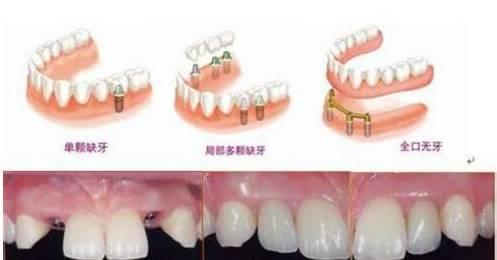 选择一个好的口腔种植牙,口腔种植牙了解一下