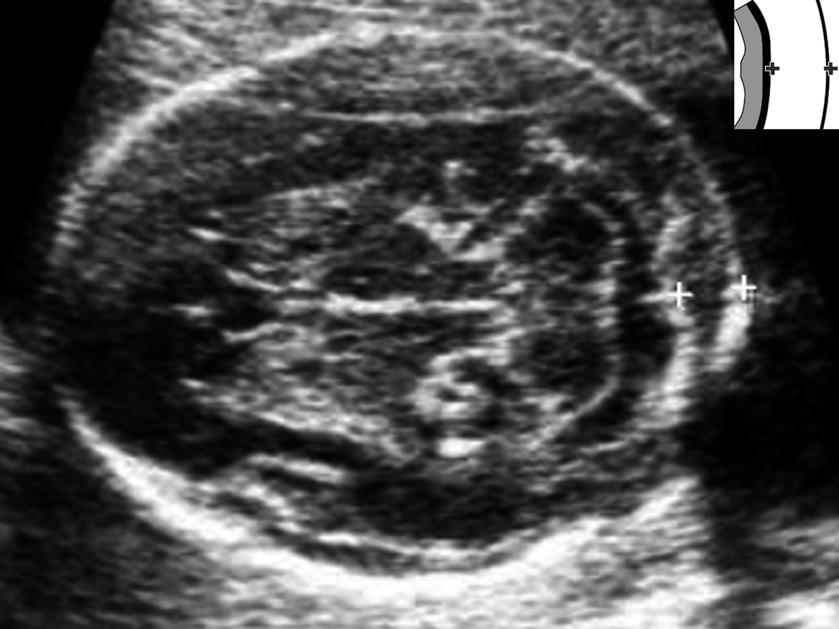 孕晚期胎儿染色体检查与基因检查,孕中期染色体异常超声指标