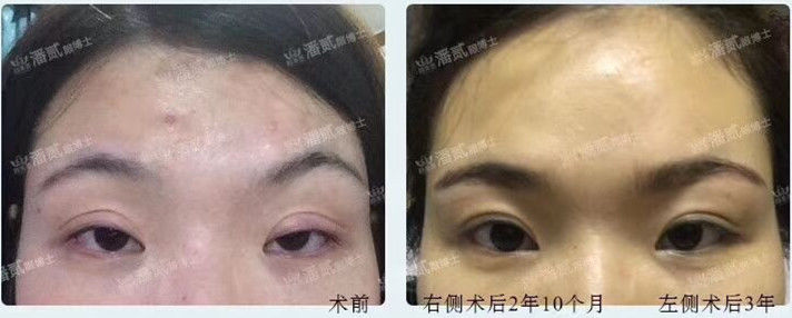 开外眼角结膜充血水肿怎么办,眼睛开外眼角有后遗症吗