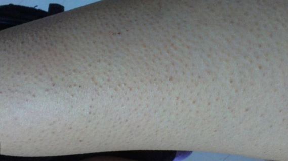 胳膊上突然起了一小片鸡皮疙瘩,胳膊上起了一片红色的像鸡皮疙瘩