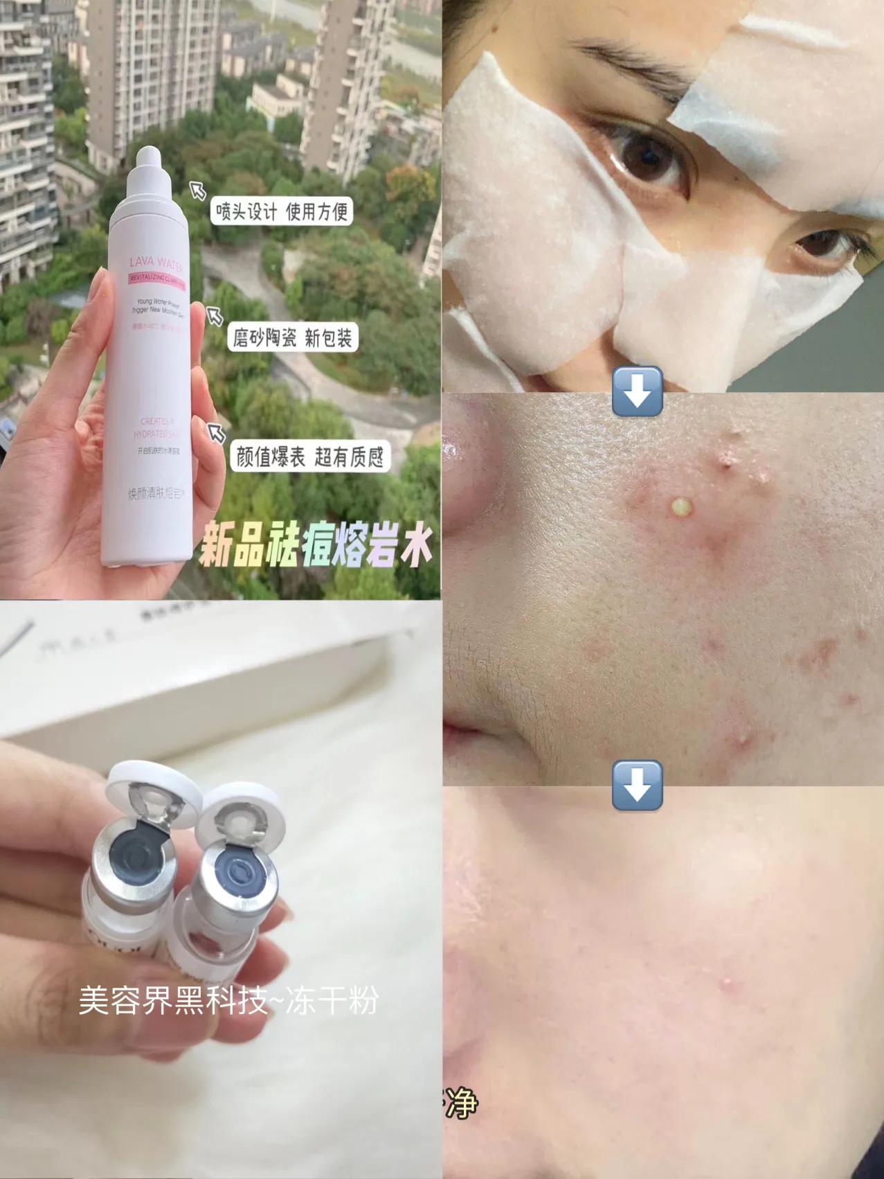 油痘肌不长痘痘了是不是快好了,油痘肌的痘痘