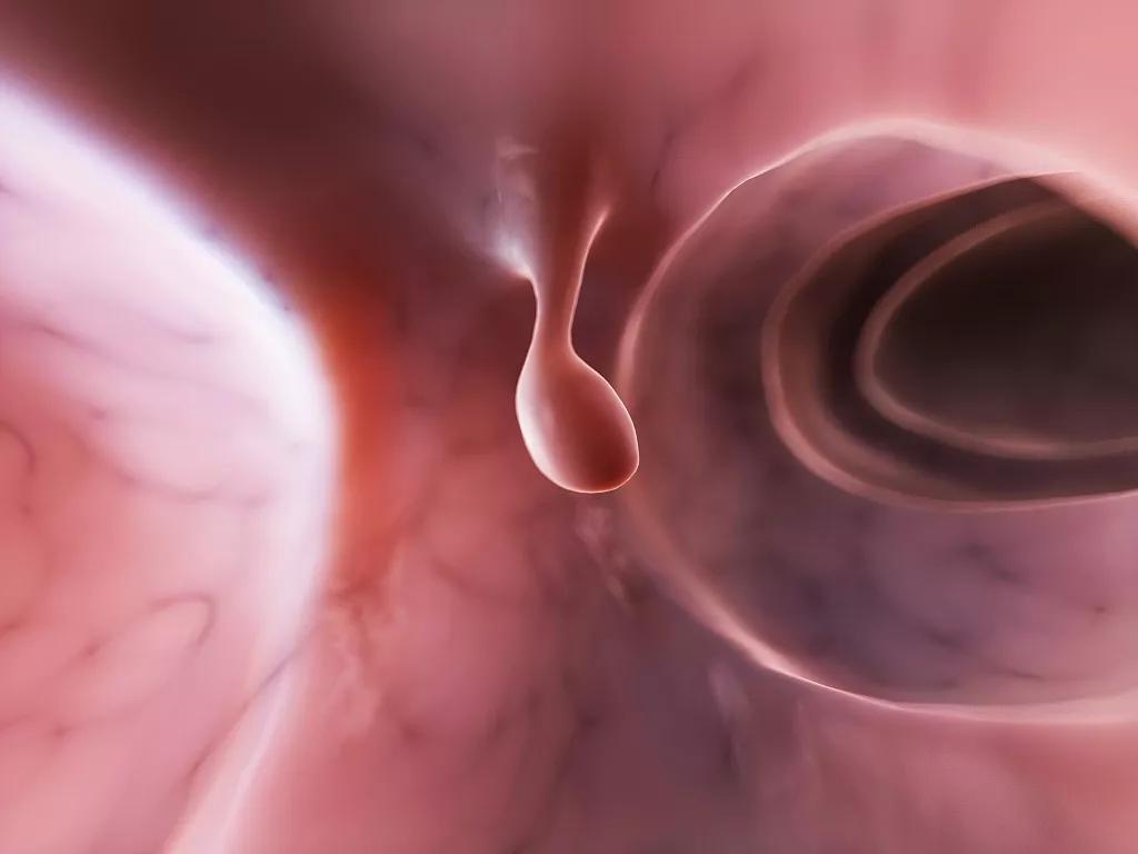 胆囊息肉19mmx10mm会变成癌不,息肉增生会不会变癌