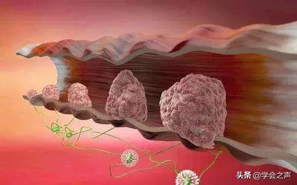 肉肿瘤最简单的去除方法,肉里长瘤子会癌变吗