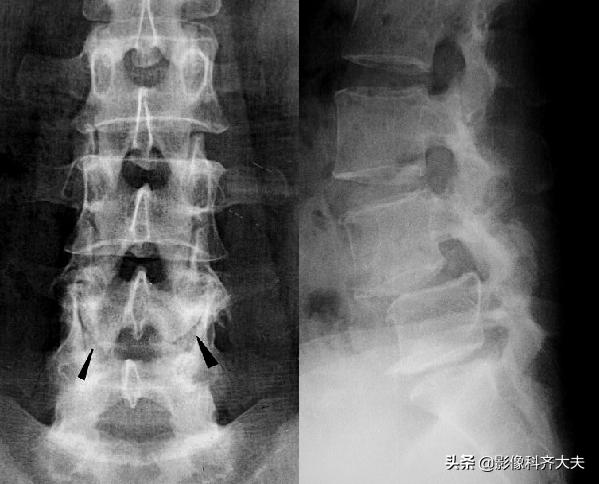骨折的影像学检查及各自的优势,骨折的影像学愈合标准