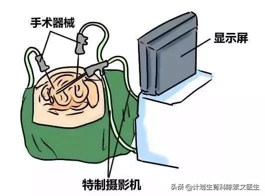 单孔腹腔镜包括哪些,3d腹腔镜与普通腹腔镜的开孔区别