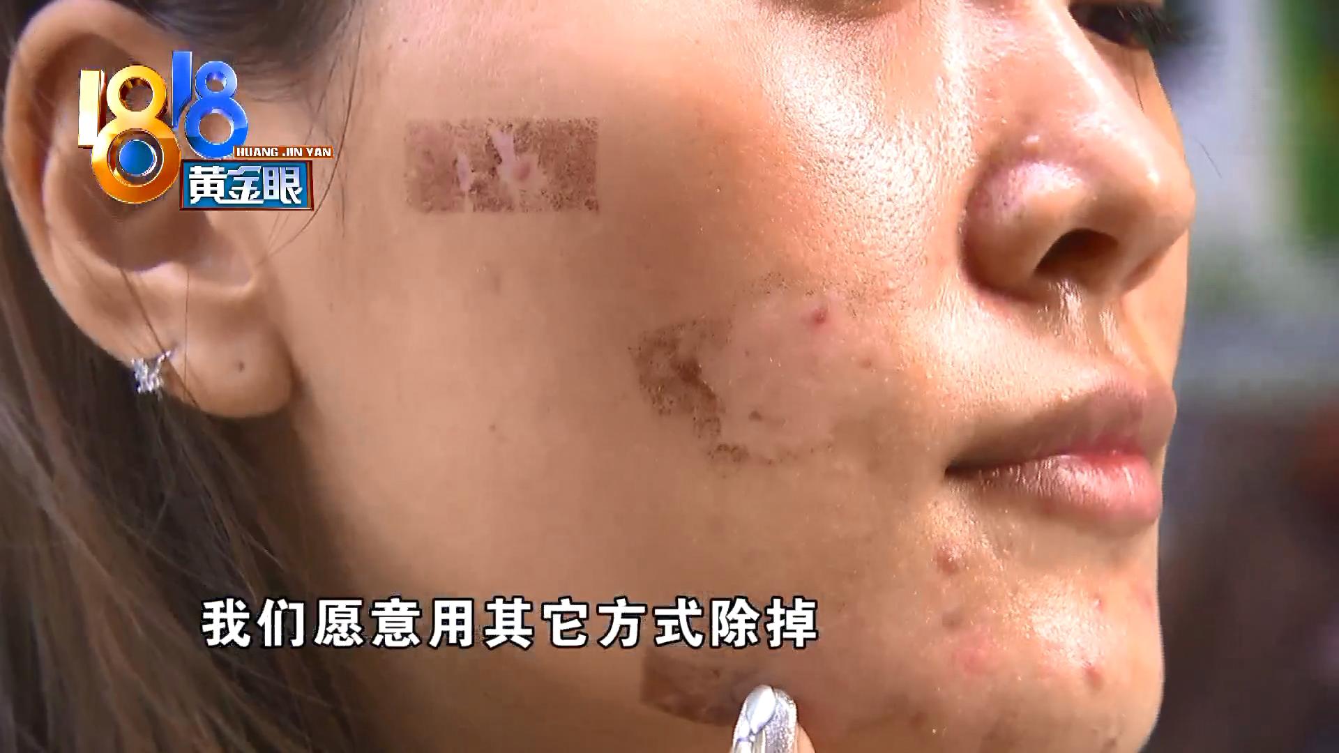 脸上有个黑色痘印一直反复结痂,脸上痘印周围红红的像结痂一样