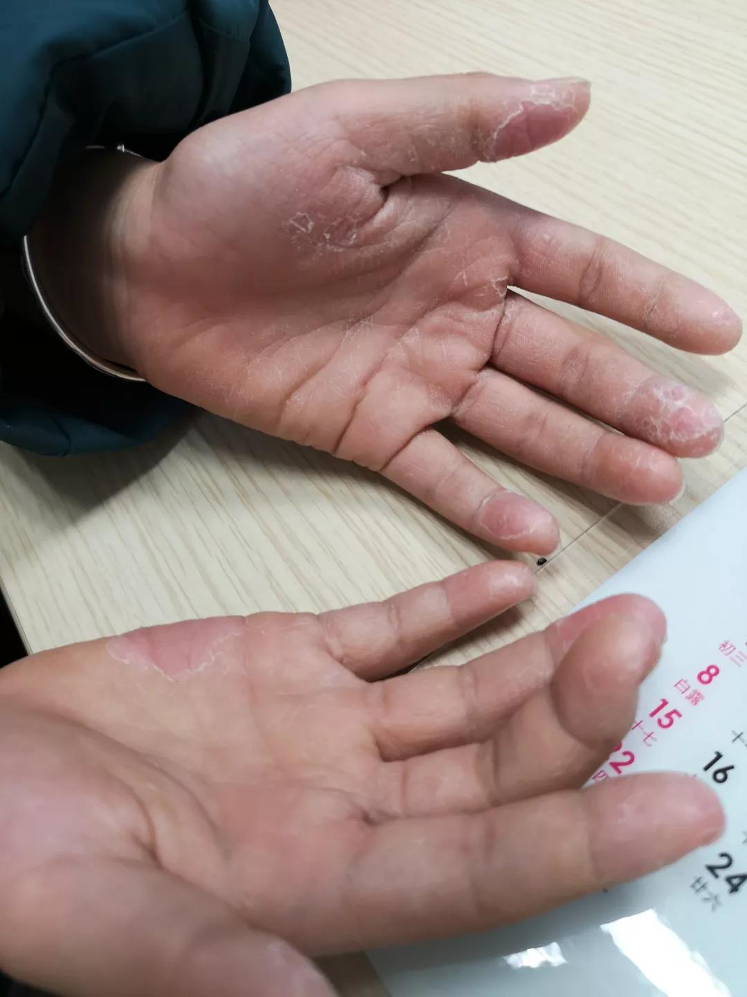 手上脱皮是什么真菌,手上脱皮真菌感染抹什么药膏好