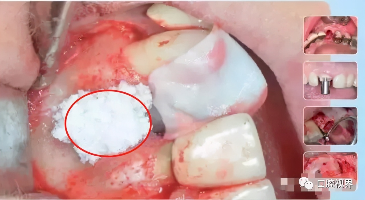 鑱婅亰鎷旂墮鐨勯偅浜涗簨鍎挎湳鍚庢仮澶嶇瘒,30骞存嫈鐗欏疄鎴樼粡楠屽垎浜嫈鐗欑柤涓嶇柤