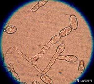 脚癣的真菌有多厉害,脚癣是什么真菌引起的可以治好