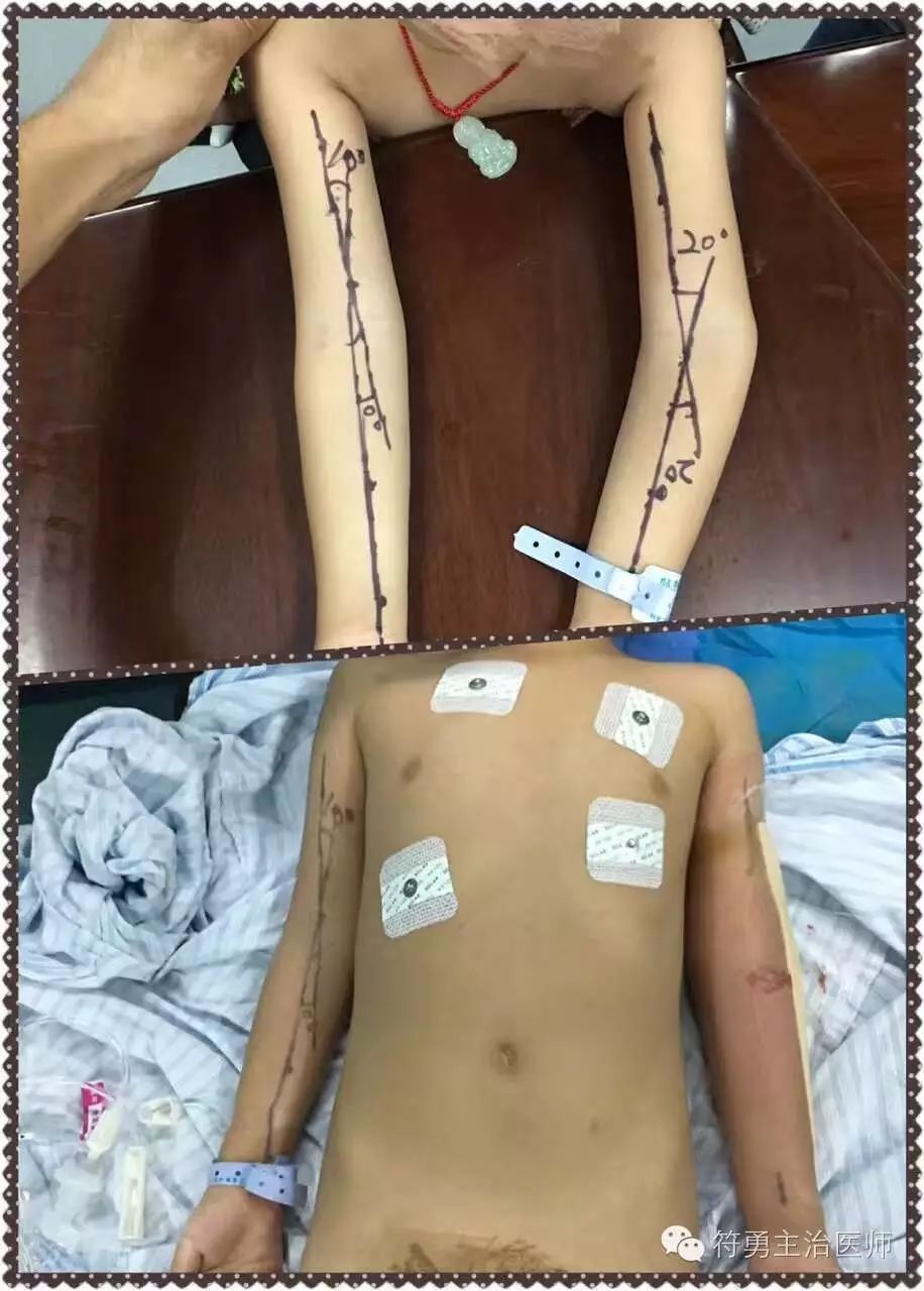 手臂肘内翻的手术效果,胳膊肘内翻矫正手术28年费用