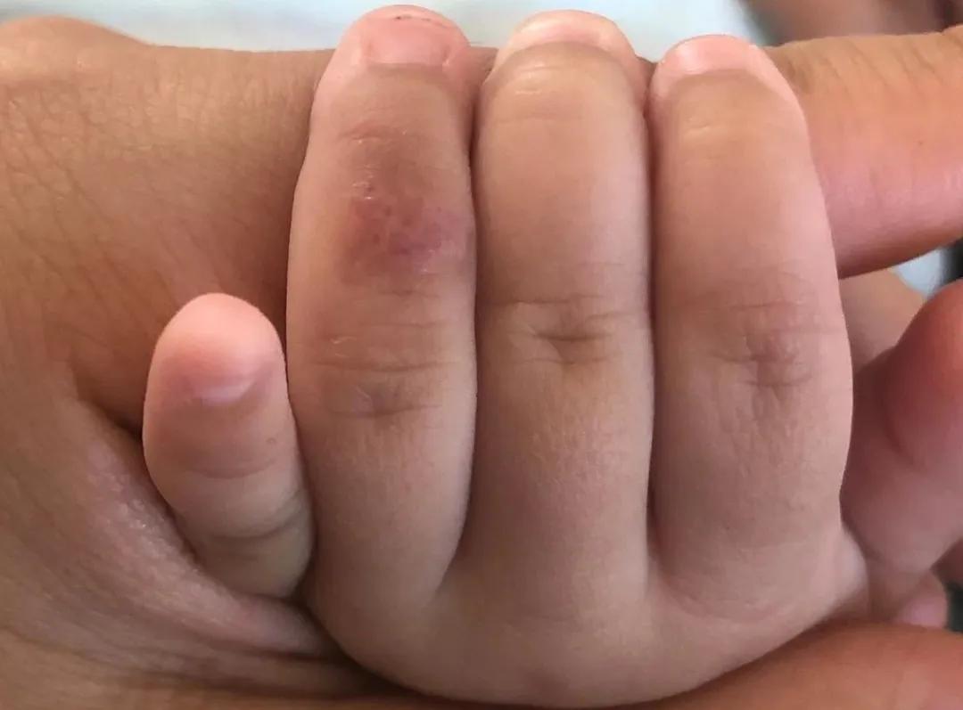 宝宝手指血管瘤治疗方法,手指头上长了个血管瘤怎么治疗