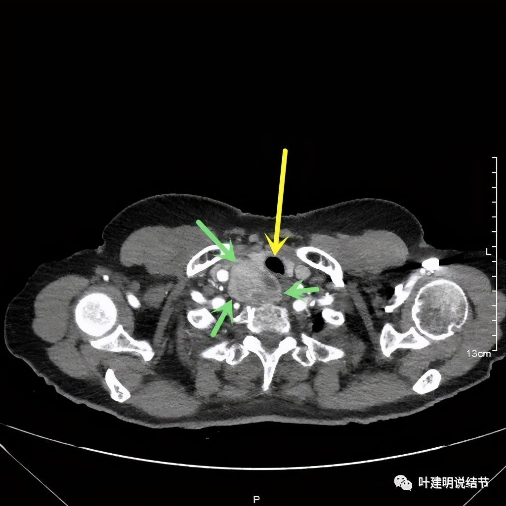 胸部高分辨ct检查注意事项,胸部ct扫描有没有危害