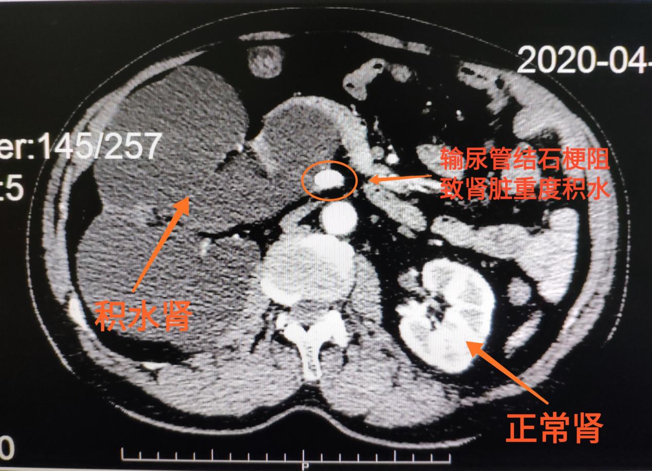 57岁男子长了枣核结石,男子长了一颗肾结石