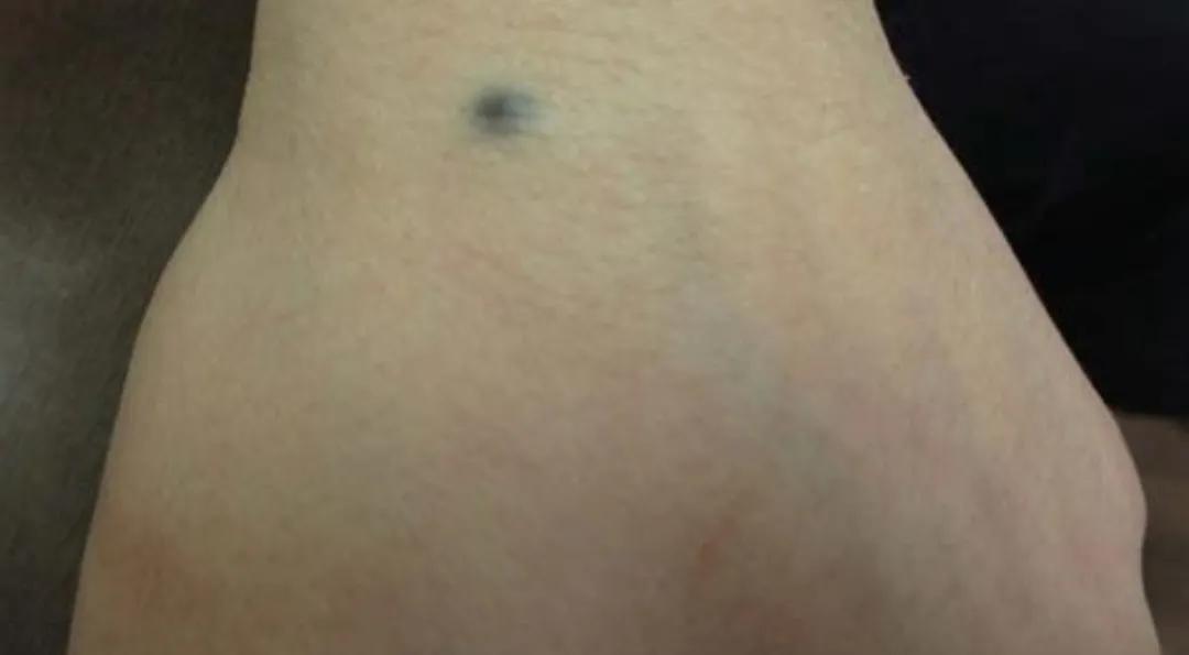 痣真的有那么大的癌变几率吗,痣会癌变真的很可怕吗