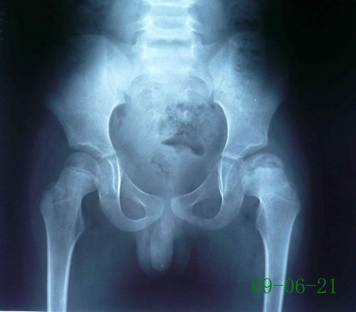 儿童股骨头坏死属于什么科,股骨头缺血性坏死一期应注意什么