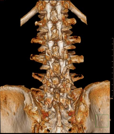腰椎管狭窄症手术好么,腰椎管狭窄手术和保守治疗哪个好