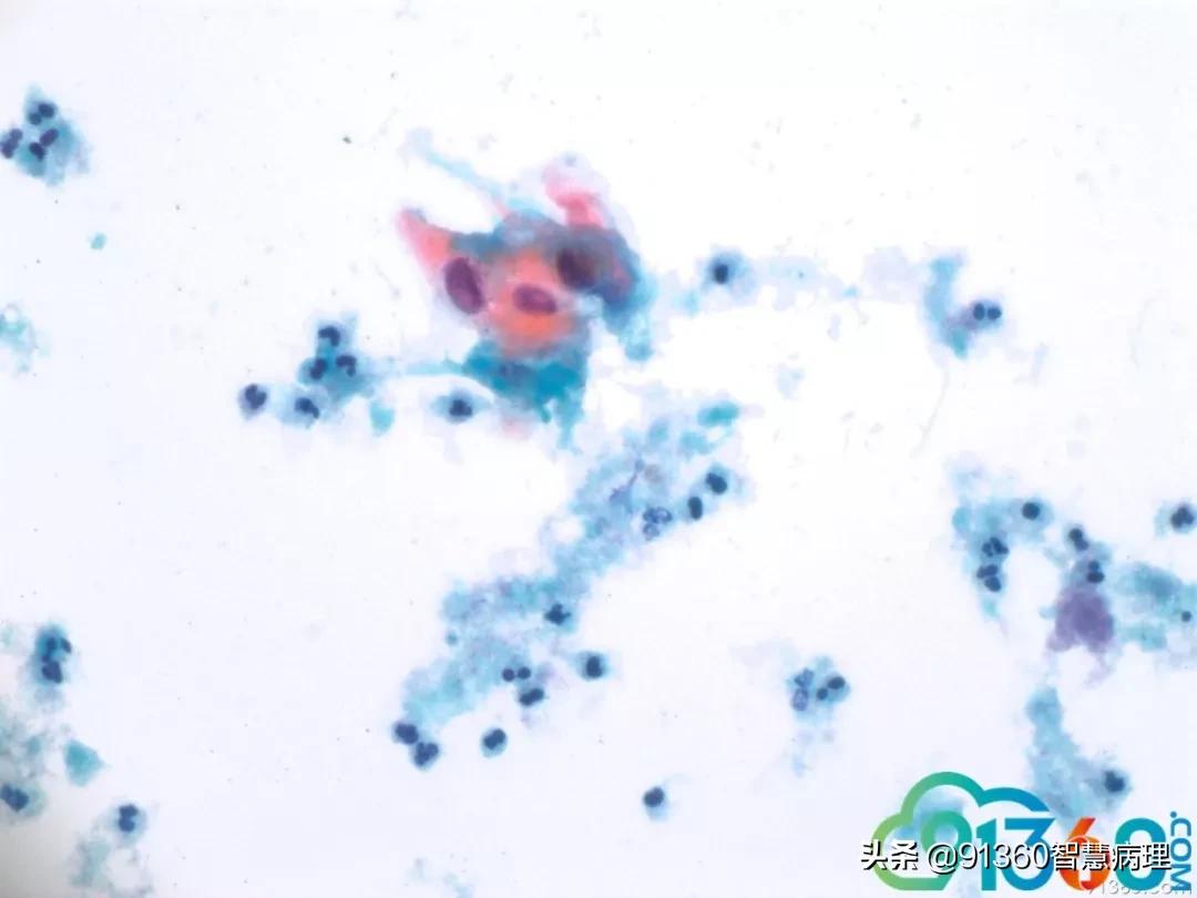 宫颈病理检查与tct检查的区别,病理诊断宫颈活检鳞癌