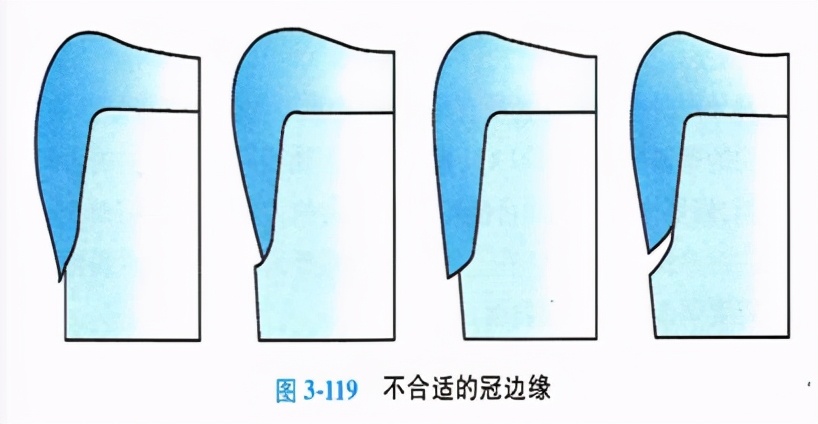 牙体缺损粘接修复术过程,口腔修复学牙体缺损的修复