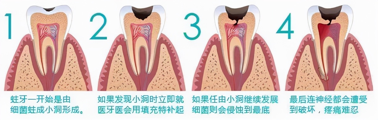 本人连续治疗12颗牙的痛快经历