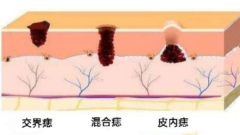 脸上有痣但不想点怎么弄掉,脸上很多痣遮不住