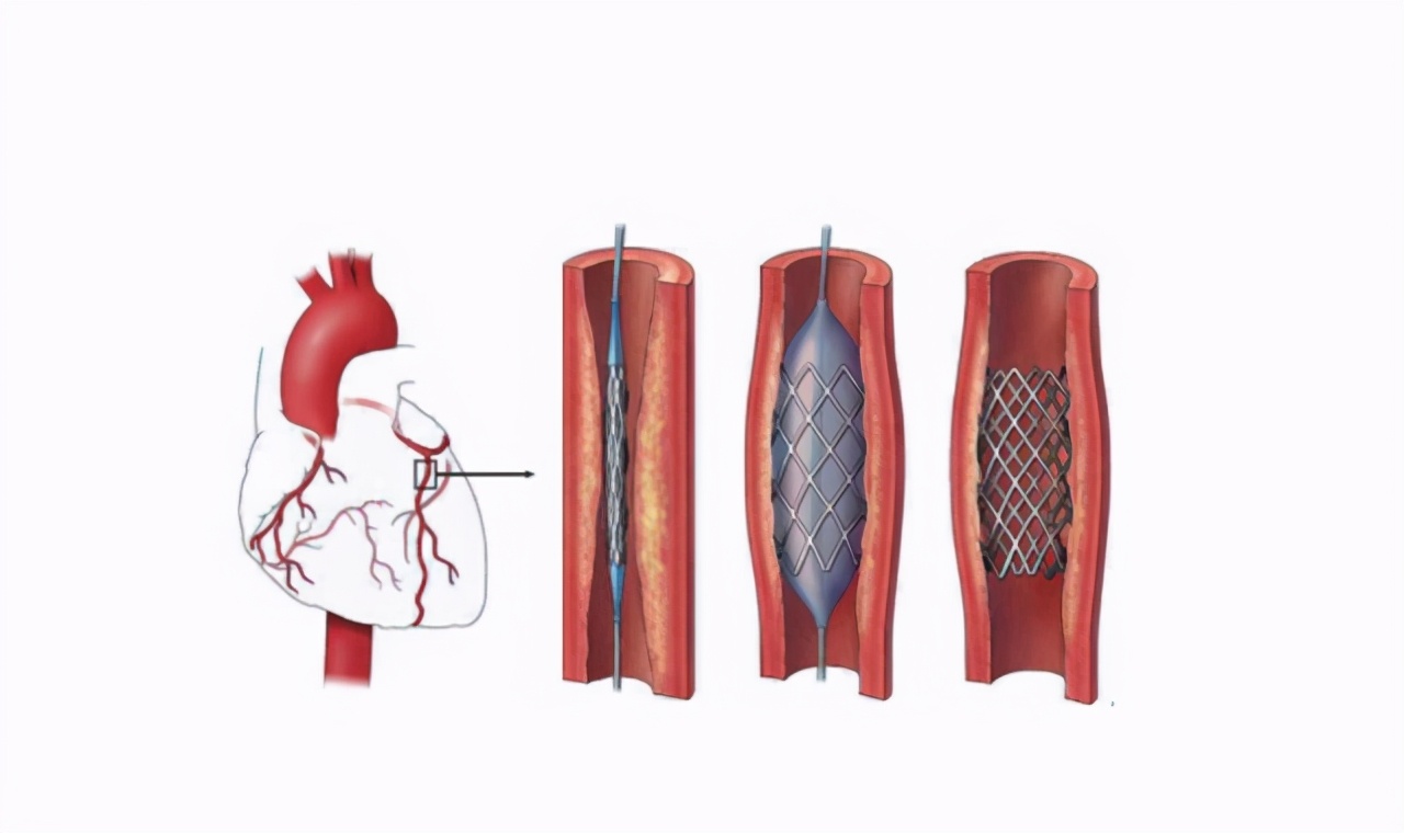 冠状动脉钙化和粥样硬化哪个严重,冠状动脉钙化和硬化哪个严重