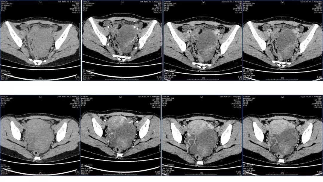 卵巢原发肿瘤的分析思路