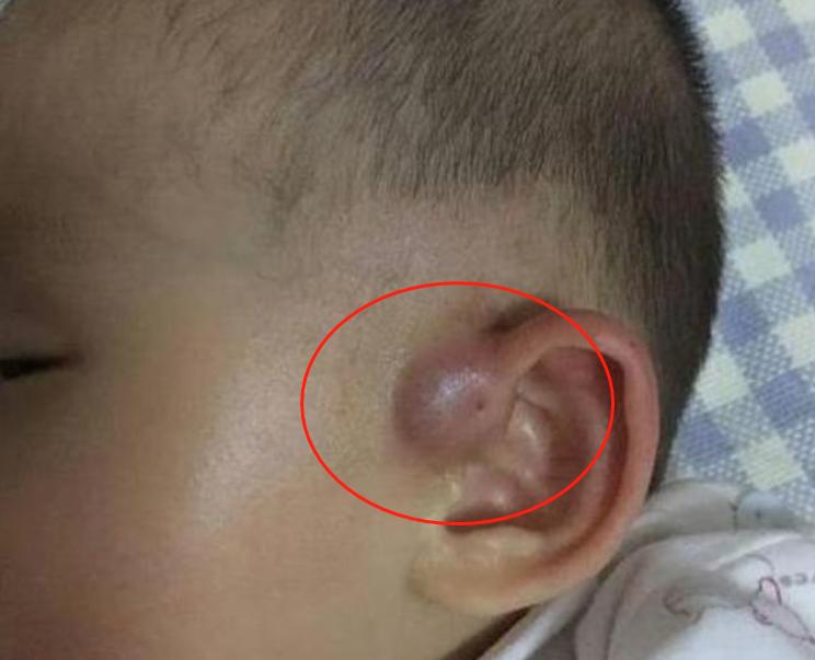 为什么婴儿耳朵上有疙瘩,为什么医生说婴儿耳朵小
