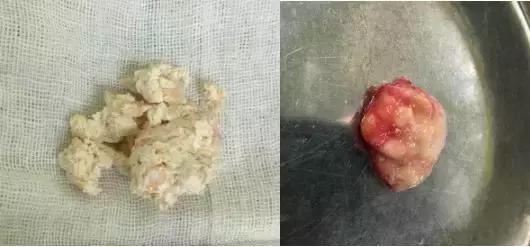 痛风脚踝有痛风石怎样才能变小,痛风石是引起痛风的根本原因吗