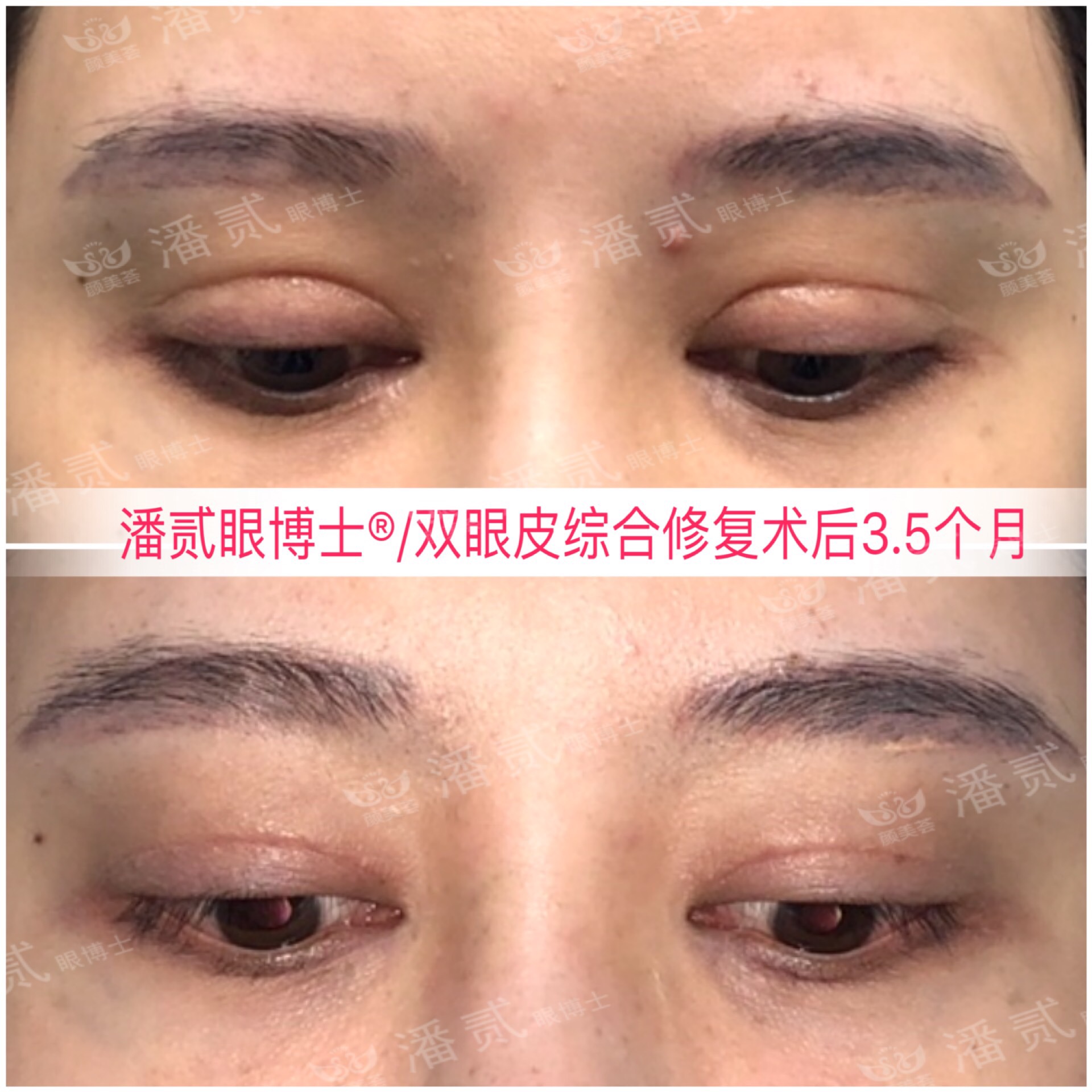 开内眼角会留疤的照片,开内眼角的疤痕变白色了怎么办