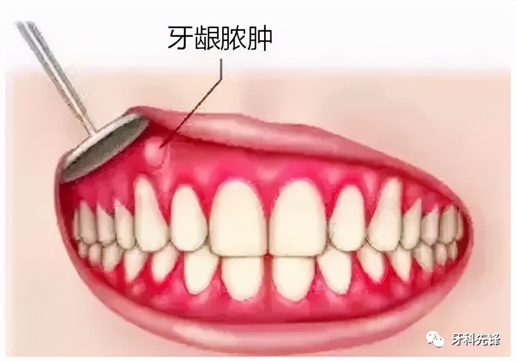 牙龈上长个脓包能把它戳破吗,牙龈上长脓包敢不敢自己戳破