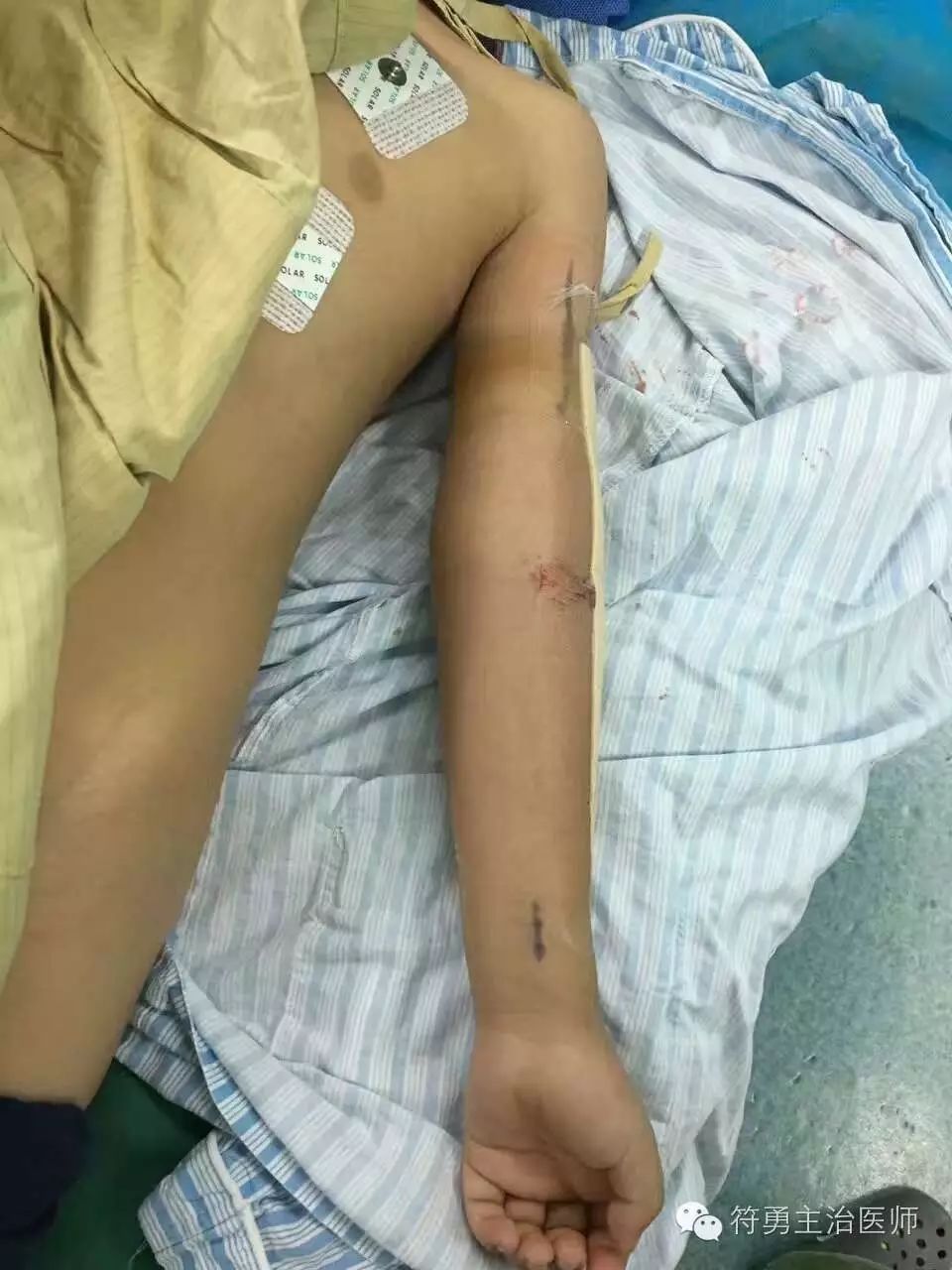 手臂肘内翻的手术效果,胳膊肘内翻矫正手术28年费用