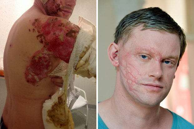 化学品灼伤案例,触目惊心的各种突发安全事故