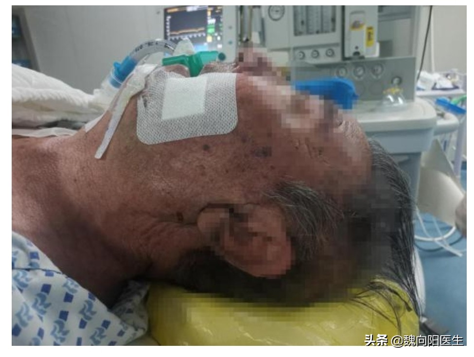 三叉神经痛面部穿刺手术要多少钱,三叉神经痛穿刺手术全过程