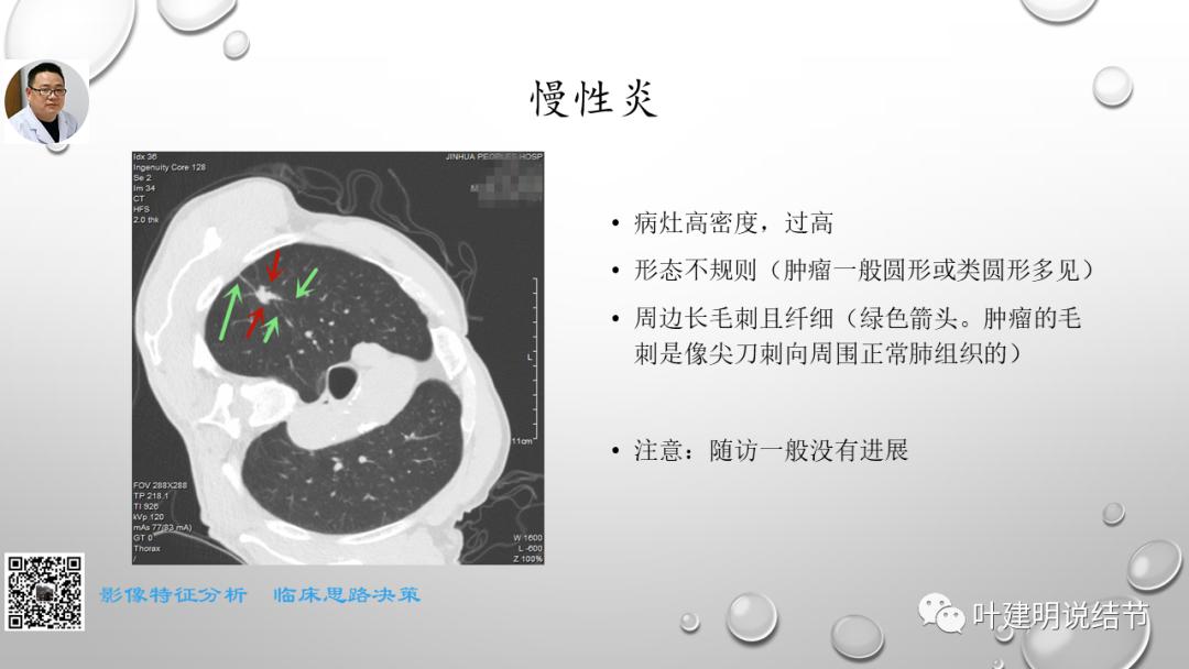 叶建明谈肺实性小结节视频,廖正银教授谈肺结节