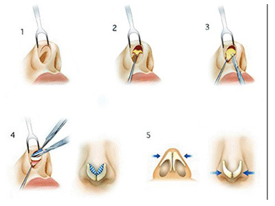 什么是鼻小柱图片,什么是鼻小柱延长