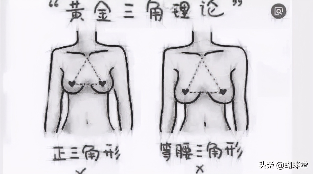 蝴蝶堂|胸部外扩，不止看起来那么简单