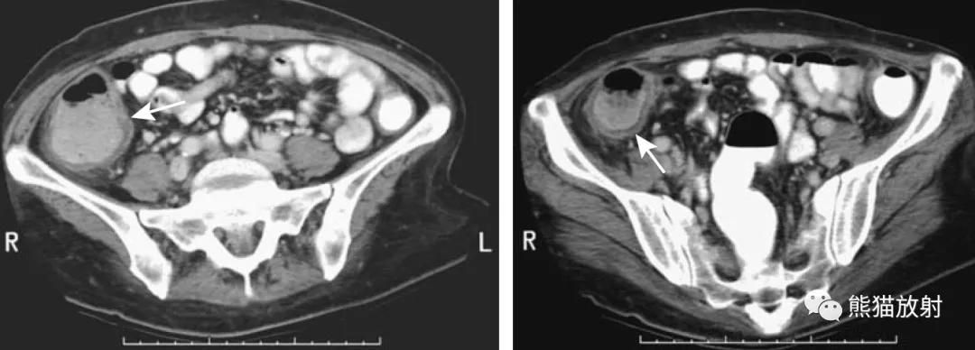 腹部影像图片大全,乙状直肠疼痛位置图片