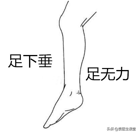 什么原因引起小腿麻木疼痛脚上无力？医生：这根神经有问题
