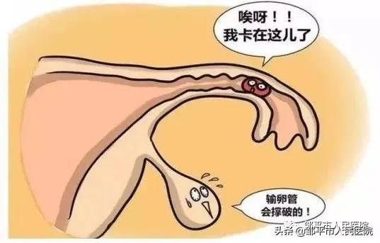 异位妊娠易发生在输卵管哪个部位,输卵管异位妊娠通常会在哪