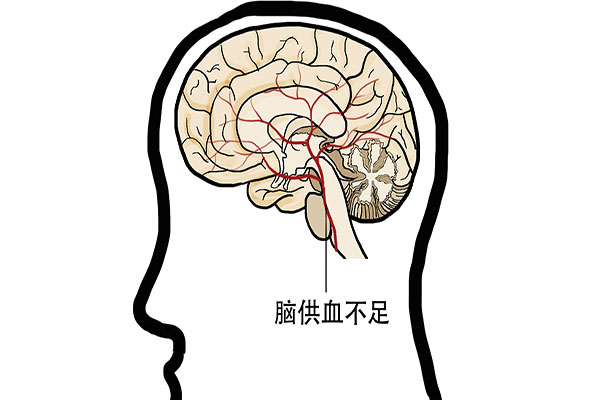 脑供血不足这5个办法帮你缓解,脑供血不足说明身体早有5大问题